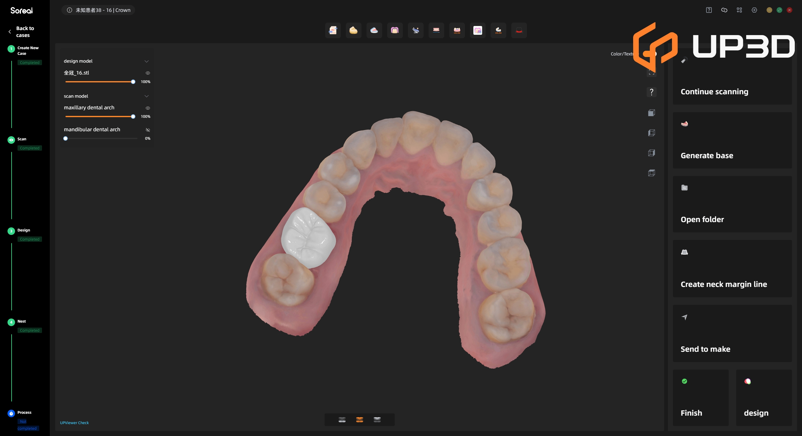 UP3D chairside AI dental CAD software interface demonstrating automated crown design on 3D dental arch model
